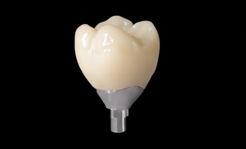 Implant  single  crowns